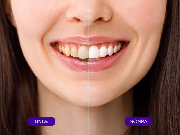 Duyora - Çift Etkili Diş Beyazlatma Bantları